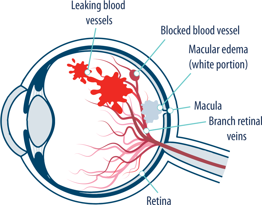 Download Eye With Macular Edema Following Retinal Vein Occlusion