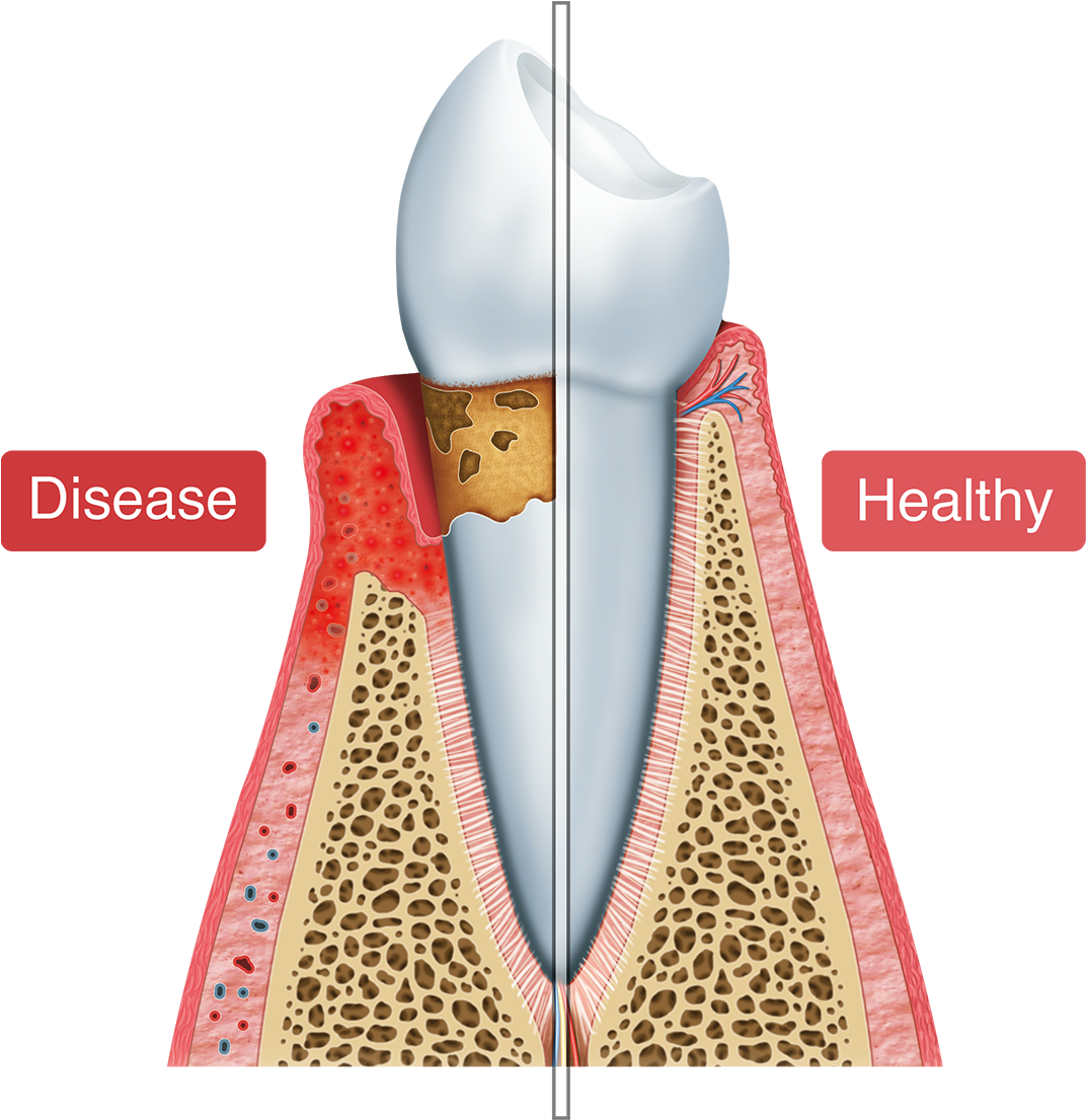 An Illustration Of Healthy Vs - Periodonto Png Clipart (1200x1200), Png Download