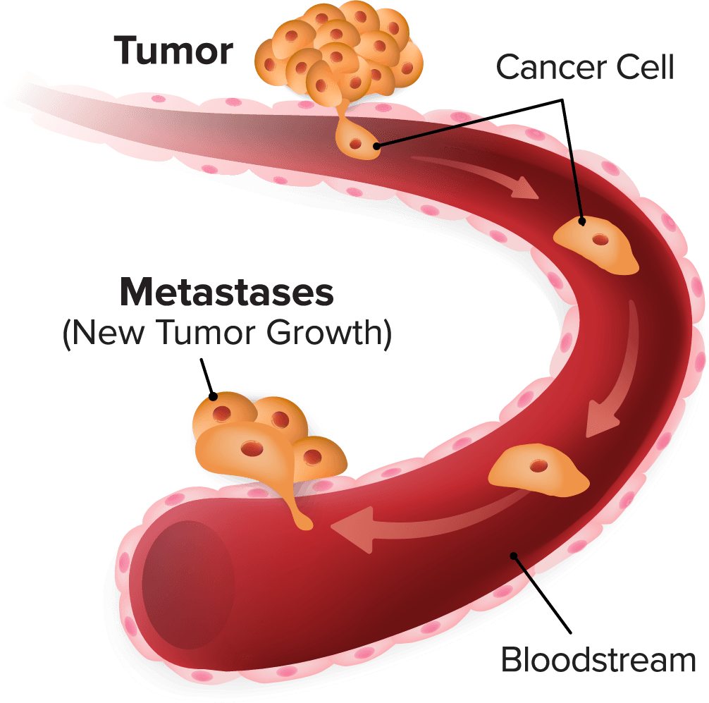 Metastasis - cancer cell metastasis clipart - large size png image - pikpng