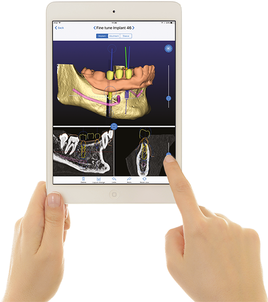 From Prosthetic To Surgical Planning - 3diemme Clipart (612x650), Png Download