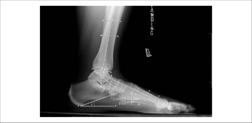 Measurements Of The Foot And Ankle On A Lateral View - Radiography Clipart (850x416), Png Download