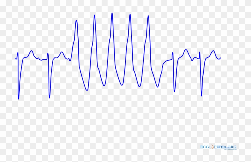 Download Ventricular Tachycardia 2 - Nsvt Ecg Clipart Png Download - PikPng