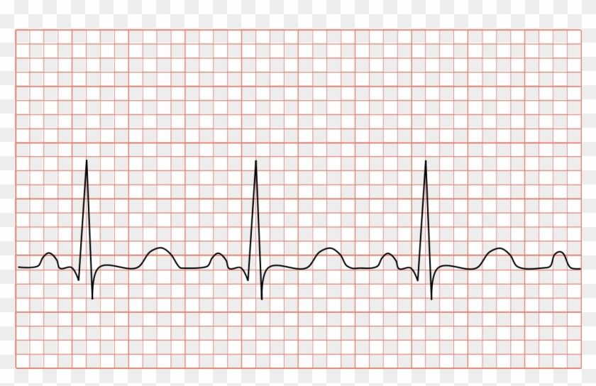 Tachycardia Svg Clipart (#2769428) - PikPng