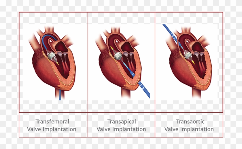 Transaortic Valve Clipart (#3950406) - PikPng