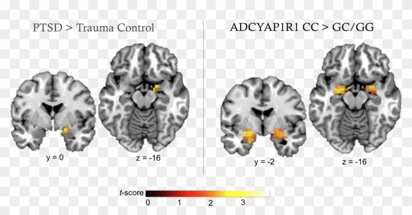 Amygdala Ptsd Mri Clipart (#4136470) - PikPng