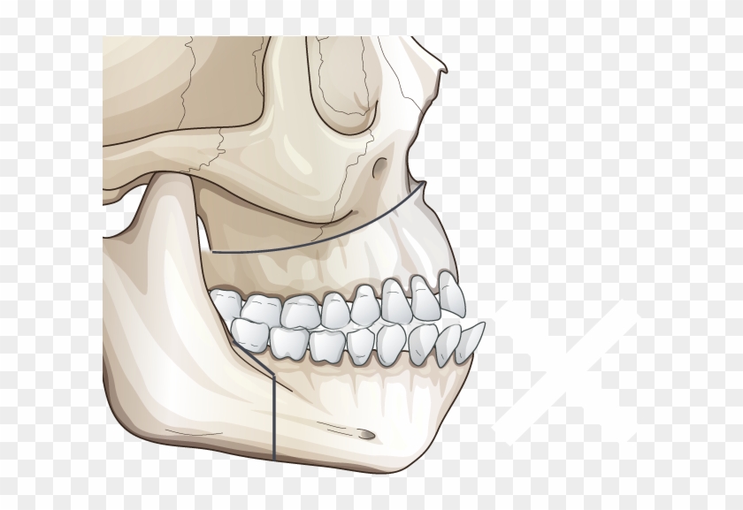 Correction With Two-jaw Surgery - X Music Festival 2017 Cardiff Clipart ...