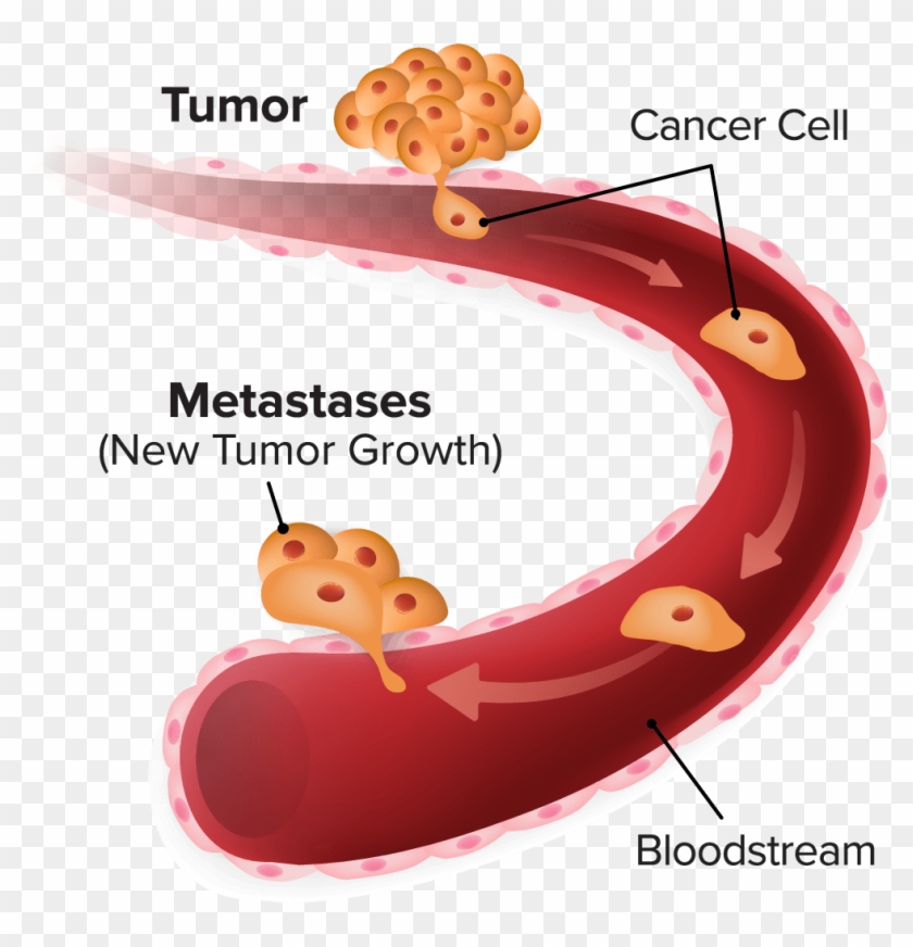 new research on cancer metastasis