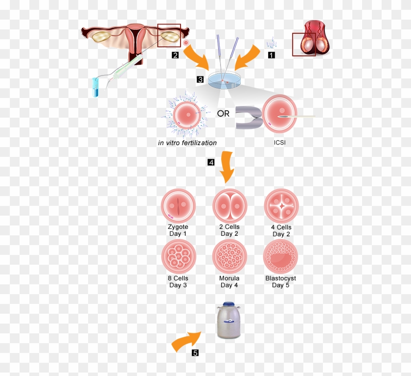 Download Embryo Banking Procedure - Icsi Ivf Clip Art - Png Download ...