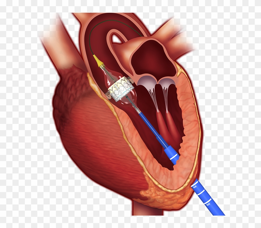 Current Team Members - Aortic Stenosis Tavi Clipart (#5697611) - PikPng